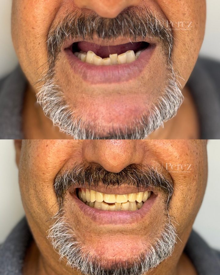 antes e depois novo 9